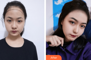 廣州新發(fā)現(xiàn)植發(fā)連鎖機(jī)構(gòu)魯聰聰整形價格表附發(fā)際線種植案例展示