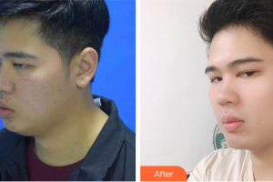 廣州韓妃醫(yī)學(xué)美容醫(yī)院金炫秀整形價格表附縮脂針案例展示