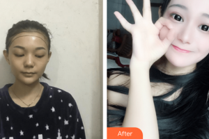 廣州新發(fā)現(xiàn)植發(fā)連鎖機(jī)構(gòu)宋振寧整形價格表附種植發(fā)際線案例展示