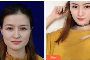 成都風(fēng)尚格致醫(yī)學(xué)美容整形醫(yī)院鄧朝東整形價格表附白竹案例展示