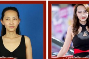 成都米蘭柏羽醫(yī)學(xué)美容醫(yī)院宋淑萍整形價格表附假體隆胸案例展示