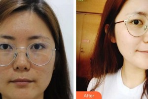 成都米蘭柏羽醫(yī)學(xué)美容醫(yī)院鄒景貴整形價格表附面部吸脂案例展示