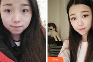 成都百齡駐顏醫(yī)學(xué)美容門診部劉寧整形價格表附眼部手術(shù)案例展示