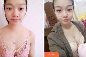 成都美容整形醫(yī)院劉來新整形價格表附濃縮豐胸真實案例展示