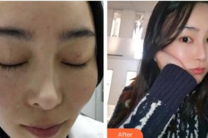 成都艾尚醫(yī)學(xué)美容門診部張桂林整形價格表附祛斑案例展示