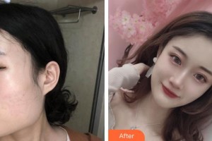 成都艾尚醫(yī)學(xué)美容門診部高亮整形價格表附下頜角整形案例展示