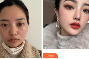 成都風(fēng)尚格致醫(yī)學(xué)美容整形醫(yī)院王曉斌整形價格表附顴骨+下頜角案例展示