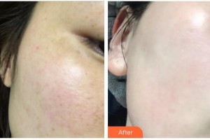 成都艾尚醫(yī)學(xué)美容門診部傅曉蓉整形價格表附光子嫩膚祛色斑案例展示