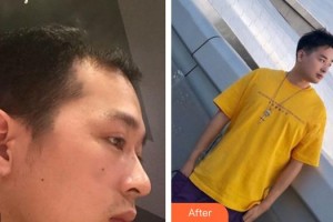 成都風(fēng)尚格致醫(yī)學(xué)美容整形醫(yī)院余正倫副教授 整形價格表附發(fā)際線案例展示