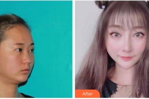 成都漢密爾頓美容醫(yī)院陳子益整形價格表附眼部整形案例展示