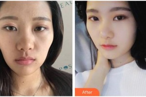 成都艾美醫(yī)療美容門診部蔣學(xué)江整形價格表附抗衰老—緊致祛皺—熱瑪吉案例展示