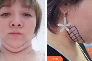 成都風(fēng)尚格致醫(yī)學(xué)美容整形醫(yī)院吳冬梅整形價格表附祛雙下巴案例展示