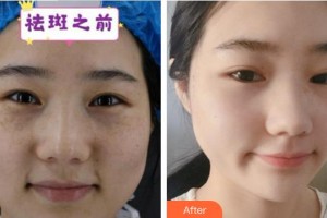 成都蜀尚蓉雅美容整形醫(yī)院羅莉萍整形價格表附激光美膚祛斑案例展示