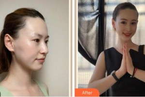 成都美容整形醫(yī)院任華英整形價格表附水氧案例展示