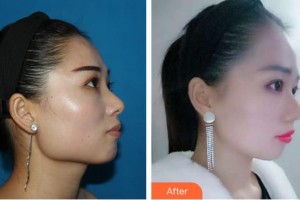 成都風(fēng)尚格致醫(yī)學(xué)美容整形醫(yī)院李繼華整形價格表附頜面整形案例展示