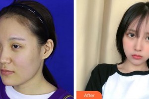 成都華顏醫(yī)療美容門診部王平整形價格表附鼻部手術(shù) 面部吸脂案例展示