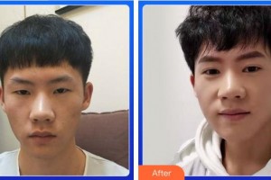 成都蜀尚蓉雅美容整形醫(yī)院常小莉整形價格表附雙眼皮案例展示