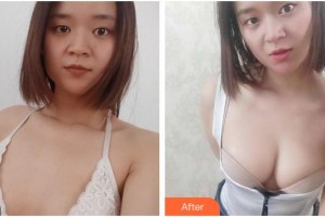 成都金榮醫(yī)學(xué)美容診所周金芳整形價格表附濃縮豐胸真實案例展示