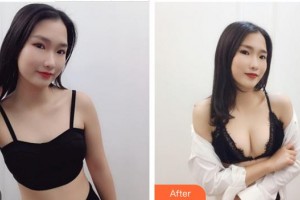 成都蜀尚蓉雅美容整形醫(yī)院張知華整形價格表附隆胸案例展示