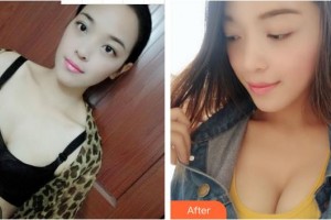 成都博雅整形門診部鄒盛勇整形價格表附隆胸案例展示