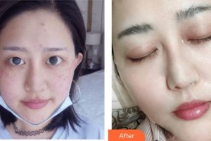 成都美瑞皮膚美容門診部鄭可揚整形價格表附激光祛斑案例展示