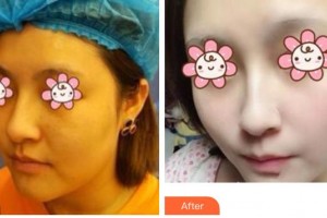 成都美瑞皮膚美容門診部高淑華整形價格表附激光祛斑案例展示