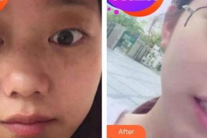 成都艾尚醫(yī)學(xué)美容門診部王琳整形價格表附祛斑案例展示