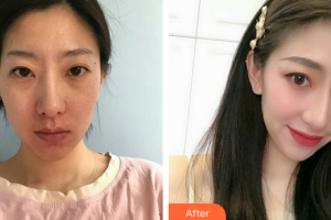 廣州膚美美容醫(yī)院夏雪形象設(shè)計(jì)師整形價(jià)格表附光子嫩膚案例展示