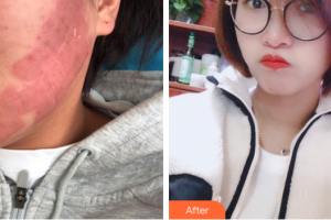 廣州紫馨美容醫(yī)院李豐霞整形價(jià)格表附點(diǎn)陣祛痘坑痘印案例展示