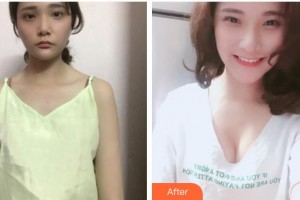 成都醫(yī)美整形美容醫(yī)院廖尚貴整形價格表附復(fù)合隆胸案例展示