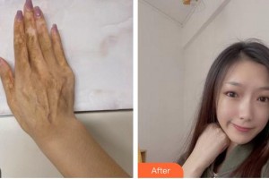 成都市第二人民醫(yī)院醫(yī)療美容科楊世清整形價格表附傷燙傷疤痕案例展示