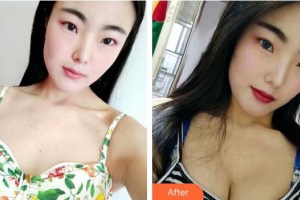 成都趙博士整形美容門診部趙善軍整形價格表附濃縮豐胸真實案例展示