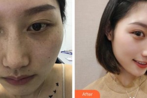 成都艾尚醫(yī)學美容門診部楊黎黎整形價格表附祛斑案例展示