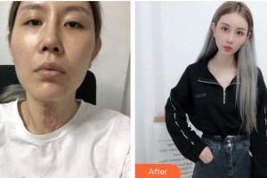 合肥劉大夫美容整形醫(yī)院徐娟整形價格表附祛疤案例展示