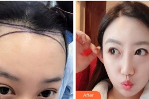 成都空軍醫(yī)院毛發(fā)移植中心趙佳整形價格表附發(fā)際線案例展示