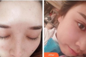 成都艾尚醫(yī)學美容門診部王超整形價格表附光子嫩膚案例展示