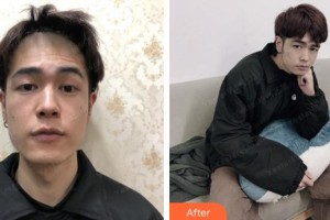 成都空軍醫(yī)院毛發(fā)移植中心劉珊珊整形價格表附發(fā)際線案例展示