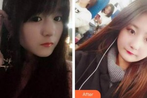 成都悅好醫(yī)學美容醫(yī)院徐凱整形價格表附牙齒根管調(diào)節(jié)案例展示