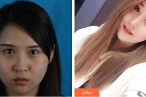 成都悅好醫(yī)學(xué)美容醫(yī)院許英哲整形價格表附鼻部手術(shù)案例展示