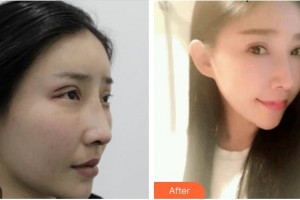 成都魅麗經(jīng)緯(原潘多拉)整形美容醫(yī)院汪妍整形價格表附雙眼皮修復(fù)案例展示