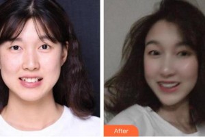 成都美容整形醫(yī)院曾晗整形價格表附隱形托槽矯正案例展示