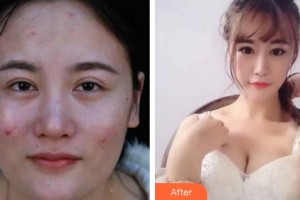 成都美瑞皮膚美容門診部馮慧潔整形價格表附光子嫩膚案例展示