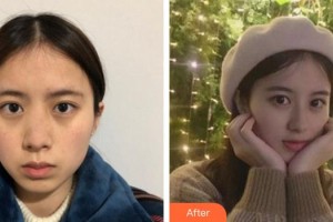 成都魅麗經(jīng)緯(原潘多拉)整形美容醫(yī)院金賢洙整形價格表附鼻部手術(shù)案例展示