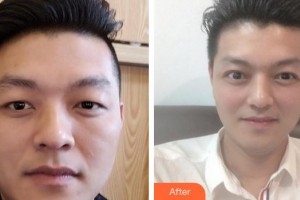 成都西區(qū)醫(yī)院醫(yī)學(xué)美容科孫文強(qiáng)整形價格表附切開雙眼皮案例展示