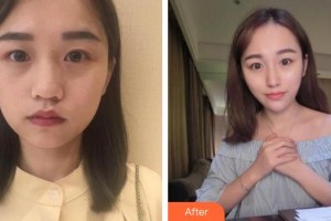 成都米蘭柏羽醫(yī)學(xué)美容醫(yī)院盧義整形價格表附熱瑪吉多方面部體驗案例展示