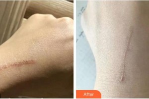 成都西區(qū)醫(yī)院醫(yī)學(xué)美容科王春聯(lián)整形價格表附祛疤案例展示