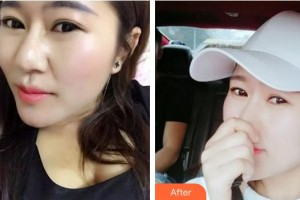 成都米蘭柏羽醫(yī)學(xué)美容醫(yī)院林楷貽整形價格表附果酸煥膚案例展示