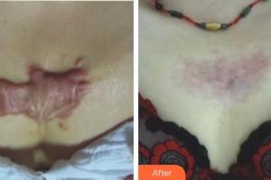 成都錦城整形美容醫(yī)院馮麗萍整形價格表附綜合調(diào)節(jié)祛疤案例展示