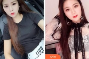 成都唯羅納醫(yī)療美容門診部張琪整形價格表附紅藍光祛痘案例展示