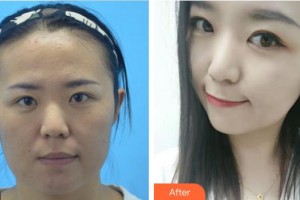 成都恒博醫(yī)院整形美容中心王英整形價格表附祛斑凈膚案例展示